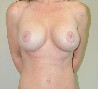 Breast Augmentation Before & After Gallery - Patient 191674721 - Image 2