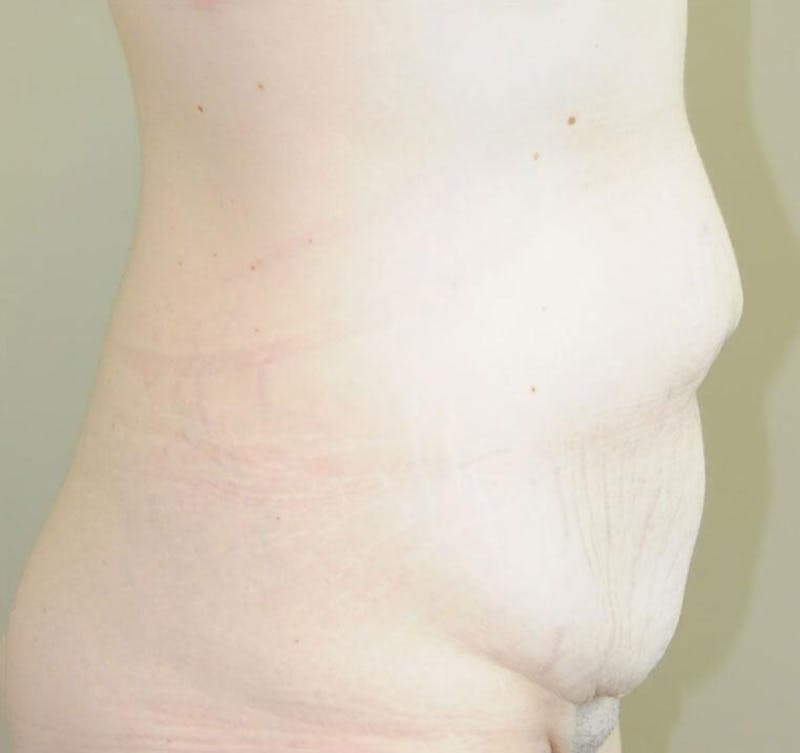 Tummy Tuck Before & After Gallery - Patient 191674720 - Image 5