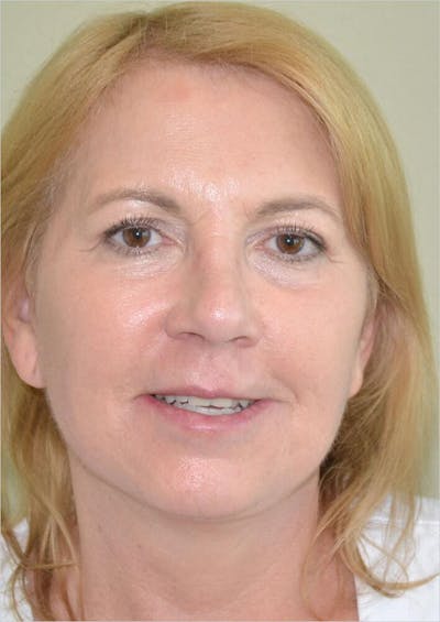 Face and Neck Lifts Before & After Gallery - Patient 191674724 - Image 2