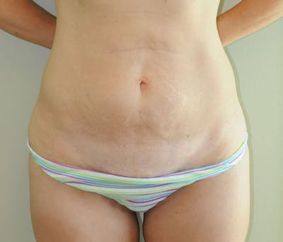Tummy Tuck Before & After Gallery - Patient 191674725 - Image 1