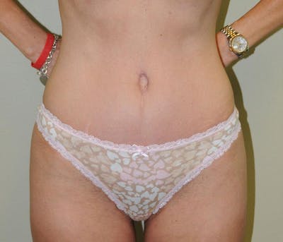 Tummy Tuck Before & After Gallery - Patient 191674725 - Image 2