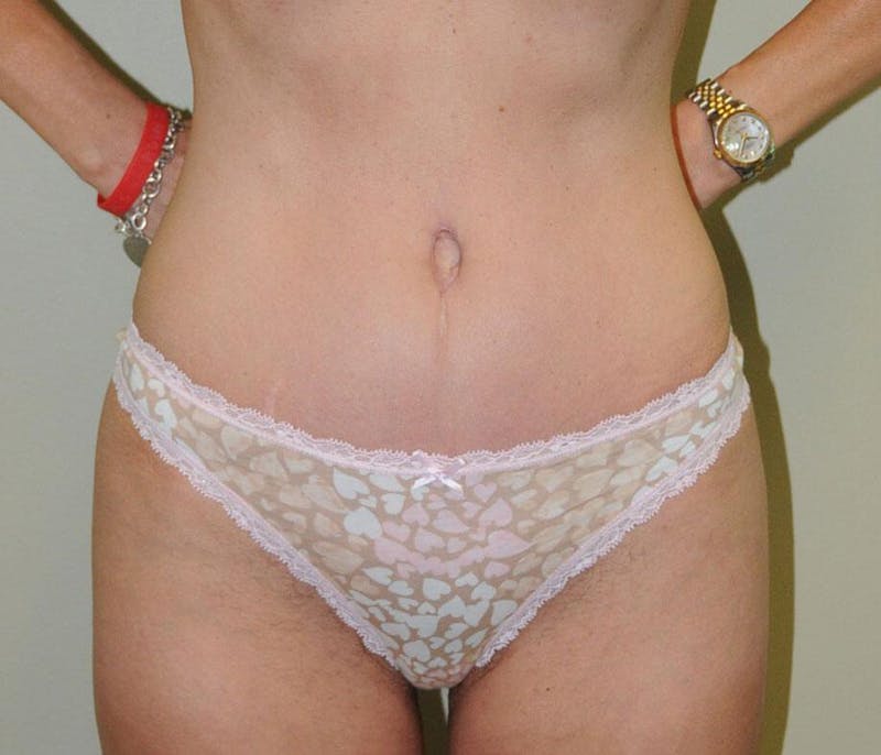 Tummy Tuck Before & After Gallery - Patient 191674725 - Image 2