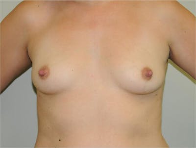 Breast Augmentation Before & After Gallery - Patient 191674727 - Image 1