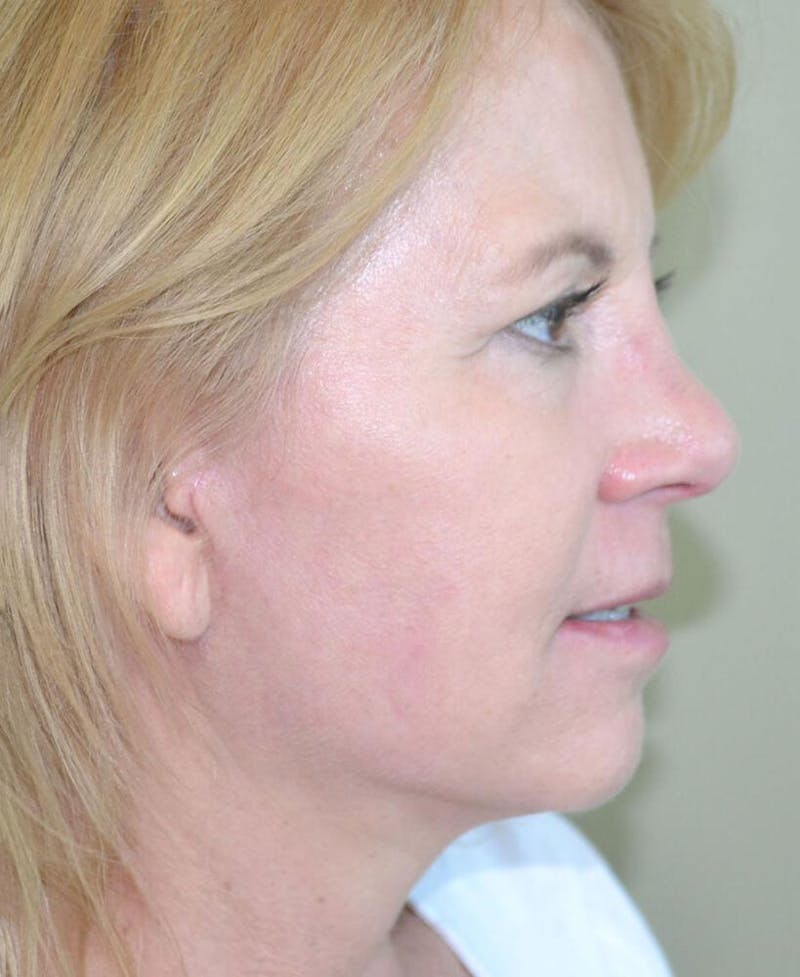 Face and Neck Lifts Before & After Gallery - Patient 191674724 - Image 6
