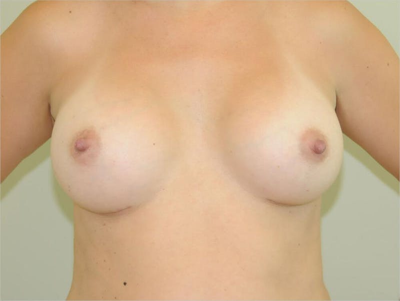 Breast Augmentation Before & After Gallery - Patient 191674727 - Image 2