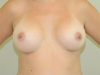 Breast Augmentation Before & After Gallery - Patient 191674727 - Image 2