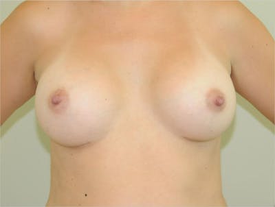 Breast Augmentation Before & After Gallery - Patient 191674727 - Image 2