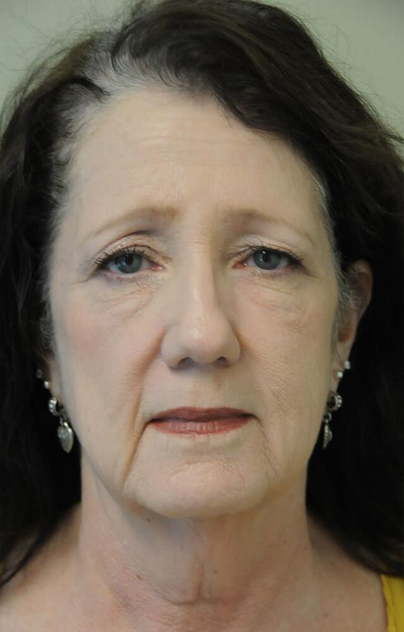 Face and Neck Lifts Before & After Gallery - Patient 191674726 - Image 1