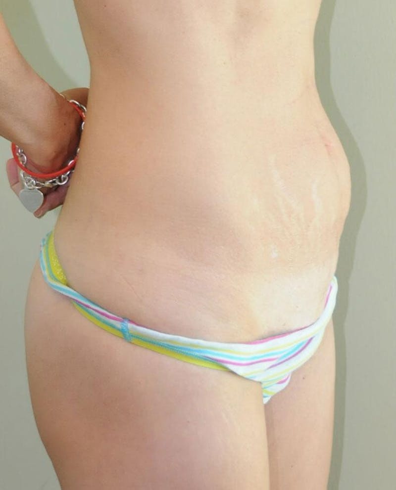 Tummy Tuck Before & After Gallery - Patient 191674725 - Image 5