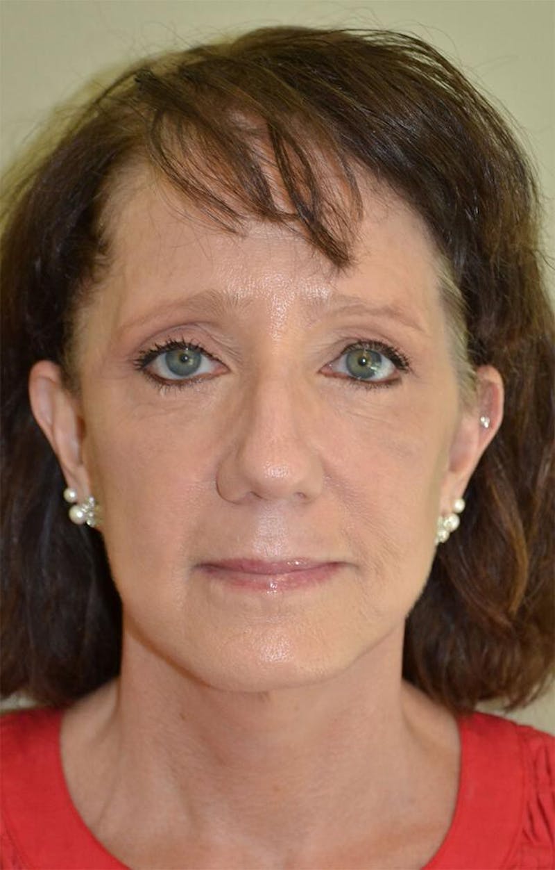 Face and Neck Lifts Before & After Gallery - Patient 191674726 - Image 2
