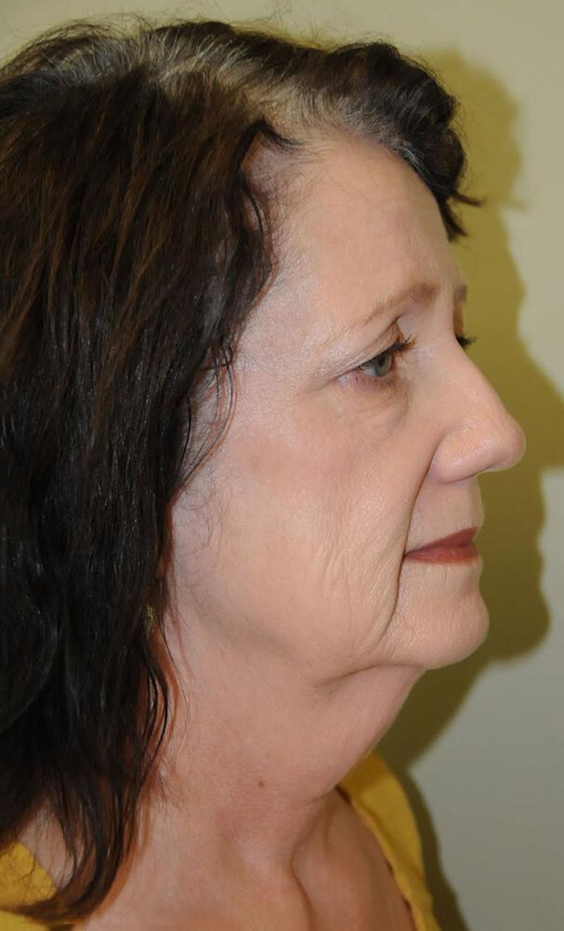 Face and Neck Lifts Before & After Gallery - Patient 191674726 - Image 3