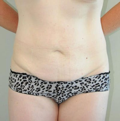 Tummy Tuck Before & After Gallery - Patient 191674728 - Image 1