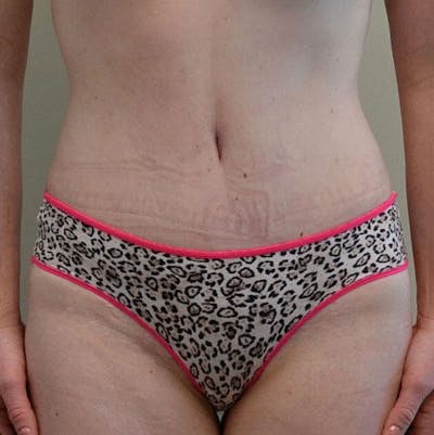 Tummy Tuck Before & After Gallery - Patient 191674728 - Image 2