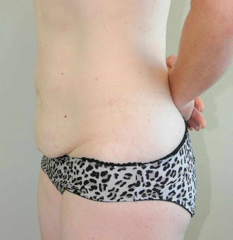 Tummy Tuck Before & After Gallery - Patient 191674728 - Image 3