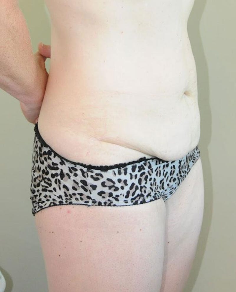Tummy Tuck Before & After Gallery - Patient 191674728 - Image 5
