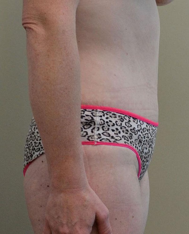 Tummy Tuck Before & After Gallery - Patient 191674728 - Image 6