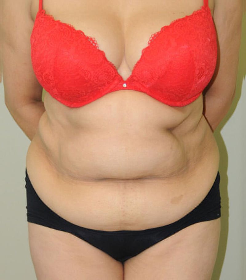 Tummy Tuck Before & After Gallery - Patient 191674732 - Image 1
