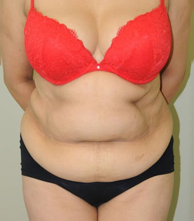 Tummy Tuck Before & After Gallery - Patient 191674732 - Image 1