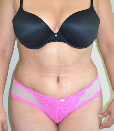 Tummy Tuck Before & After Gallery - Patient 191674732 - Image 2