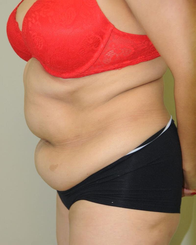Tummy Tuck Before & After Gallery - Patient 191674732 - Image 3