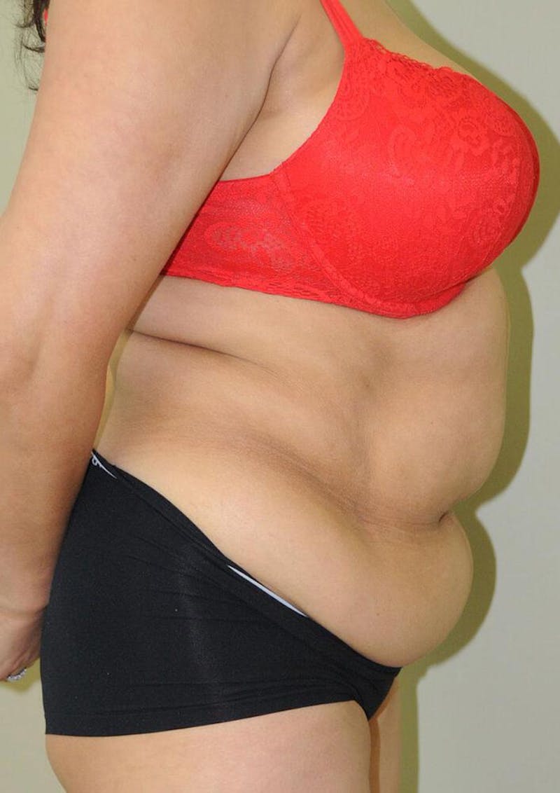 Tummy Tuck Before & After Gallery - Patient 191674732 - Image 5
