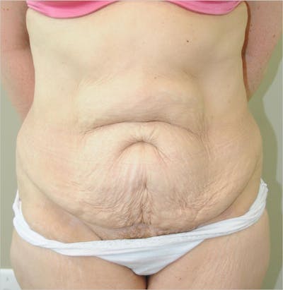 Tummy Tuck Before & After Gallery - Patient 191674734 - Image 1