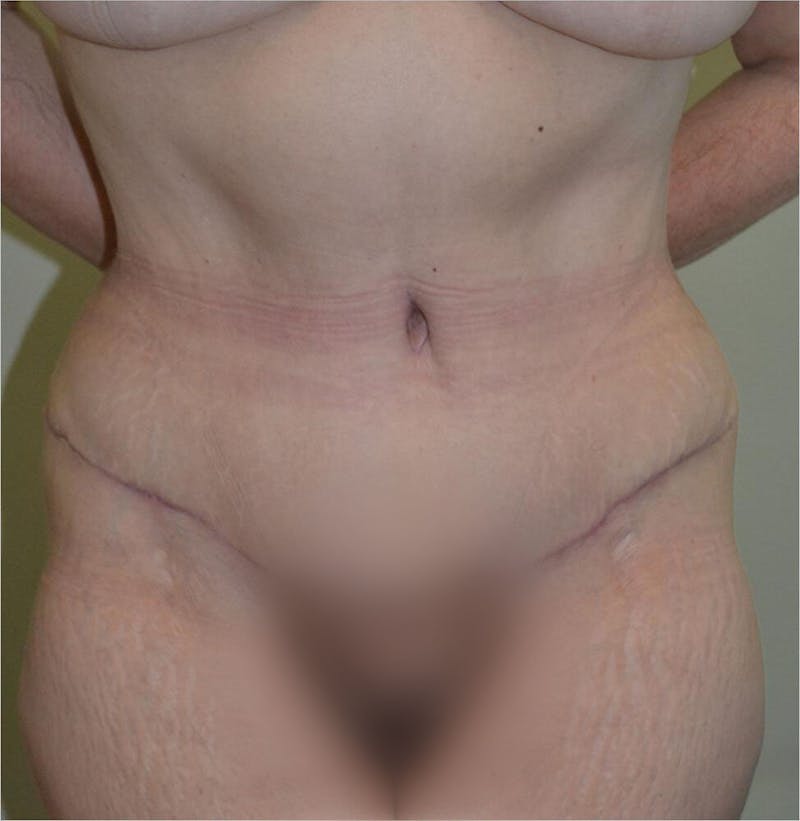 Tummy Tuck Before & After Gallery - Patient 191674734 - Image 2