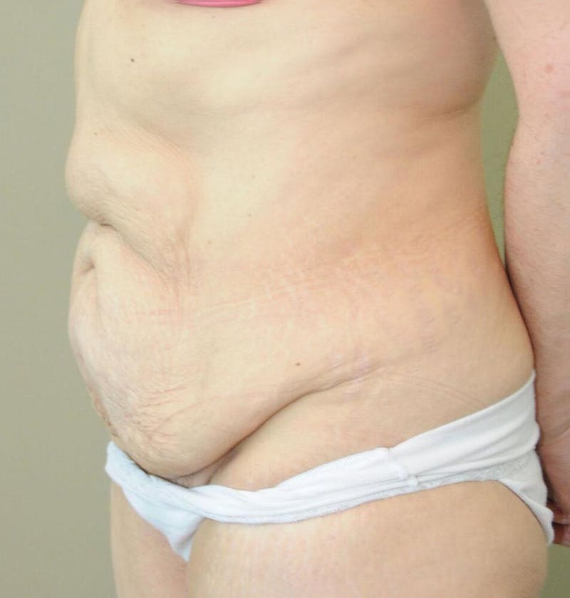 Tummy Tuck Before & After Gallery - Patient 191674734 - Image 3