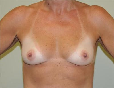 Breast Augmentation Before & After Gallery - Patient 191674737 - Image 1
