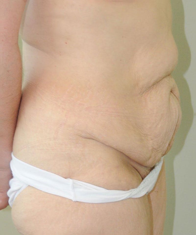Tummy Tuck Before & After Gallery - Patient 191674734 - Image 5