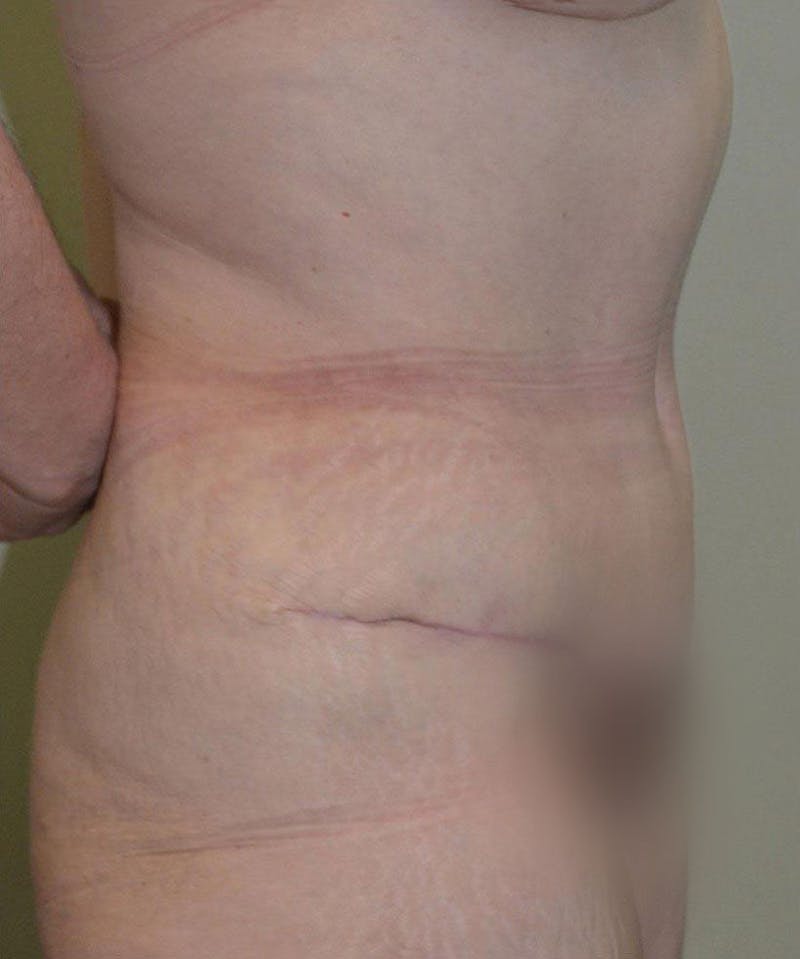 Tummy Tuck Before & After Gallery - Patient 191674734 - Image 6