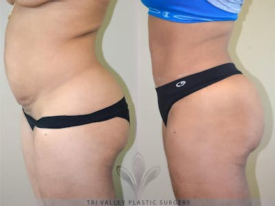 Tummy Tuck Before & After Gallery - Patient 191674735 - Image 1