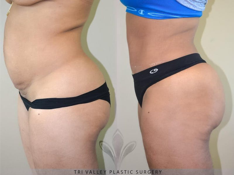 Tummy Tuck Before & After Gallery - Patient 191674735 - Image 1