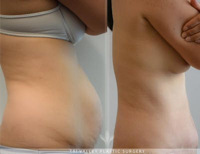 Tummy Tuck Before & After Gallery - Patient 191674738 - Image 1