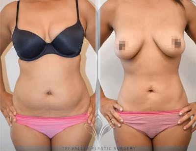 Tummy Tuck Before & After Gallery - Patient 191674739 - Image 1