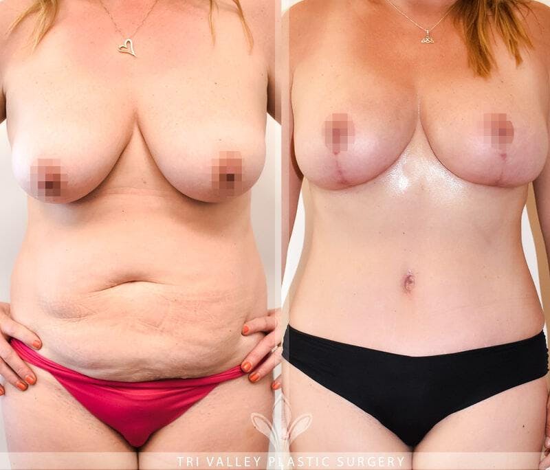 Tummy Tuck Before & After Gallery - Patient 191674743 - Image 1