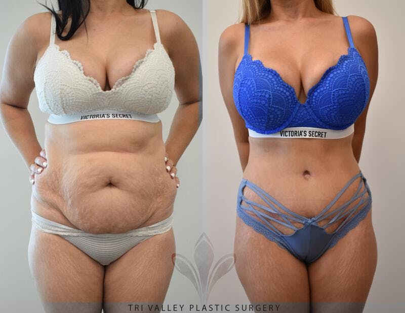 Tummy Tuck Before & After Gallery - Patient 191674745 - Image 1