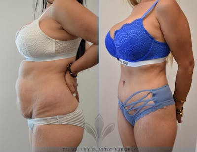 Tummy Tuck Before & After Gallery - Patient 191674745 - Image 2