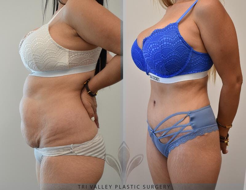 Tummy Tuck Before & After Gallery - Patient 191674745 - Image 2