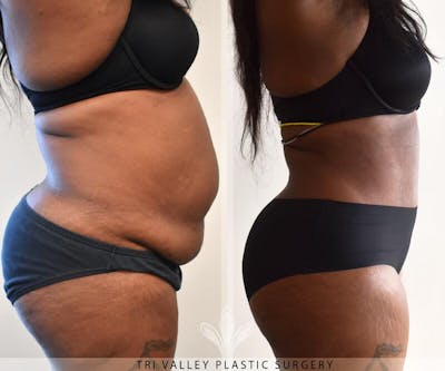 Tummy Tuck Before & After Gallery - Patient 191674746 - Image 1