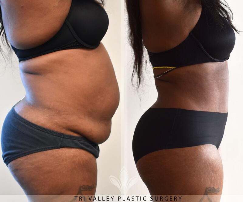 Tummy Tuck Before & After Gallery - Patient 191674746 - Image 1