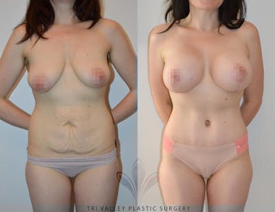 Tummy Tuck Before & After Gallery - Patient 191674748 - Image 1