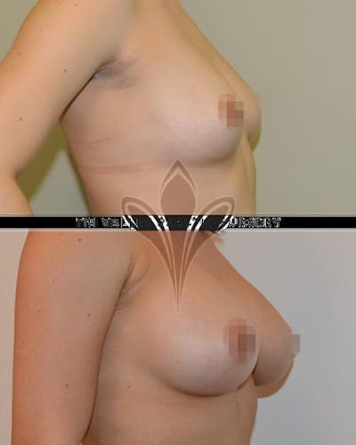 Breast Augmentation Before & After Gallery - Patient 191674789 - Image 1