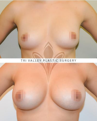 Breast Augmentation Before & After Gallery - Patient 191674789 - Image 2