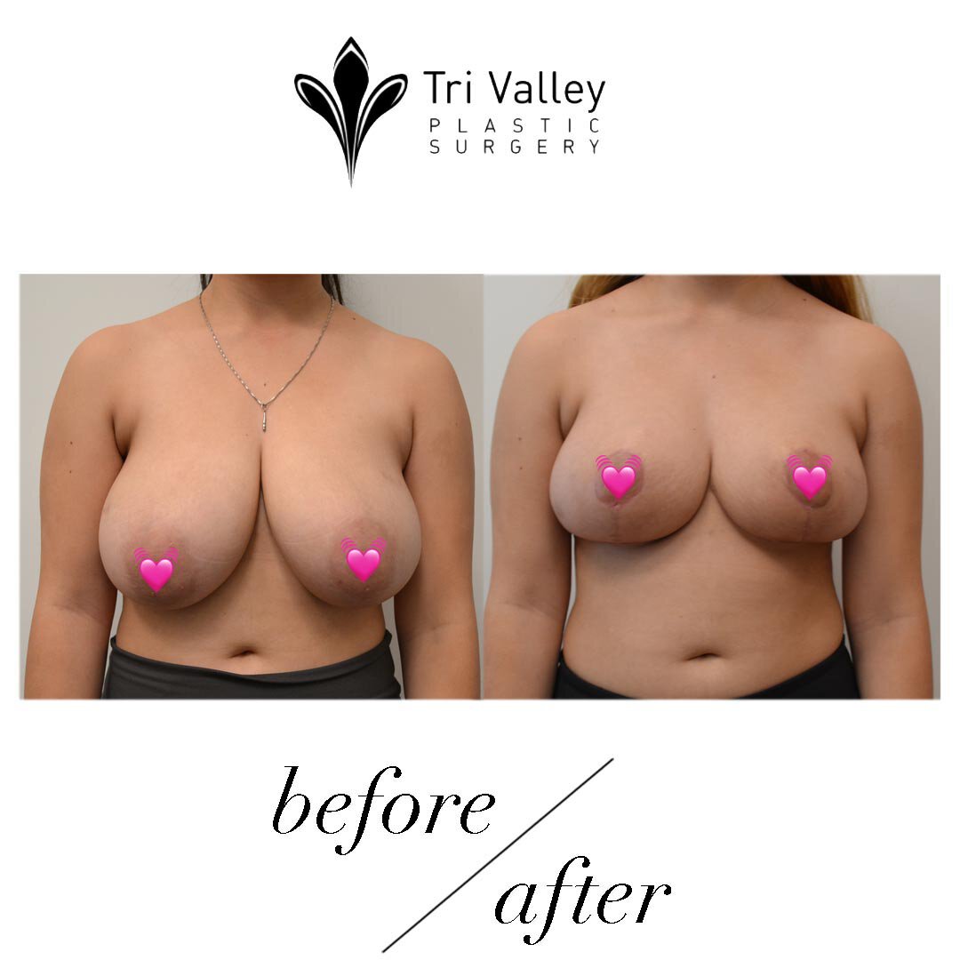 A College Student's POV On Her Breast Reduction Surgery