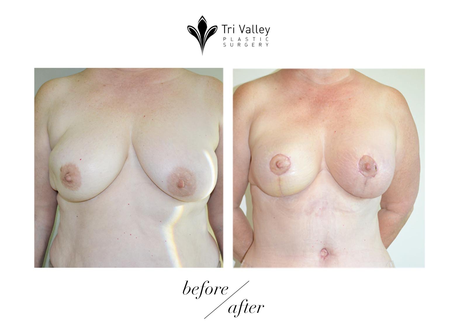 Oakland breast reconstruction before and after photos