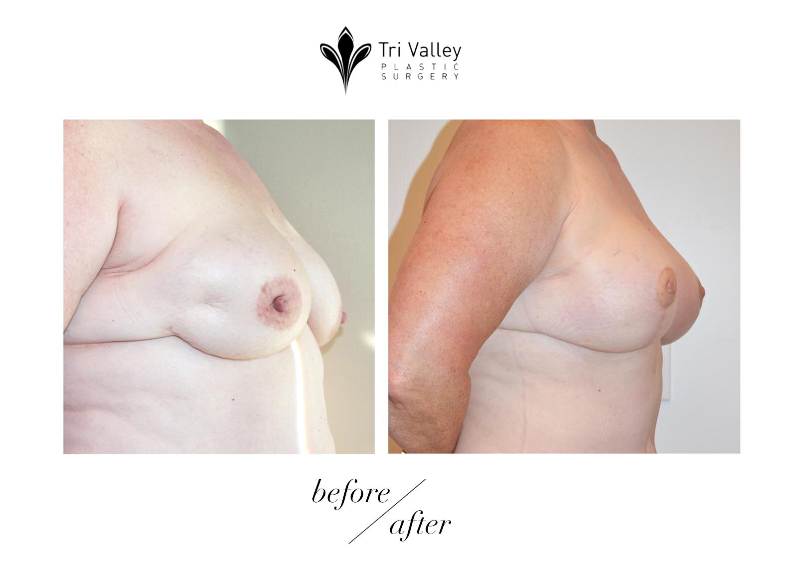 Oakland breast reconstruction before and after photos