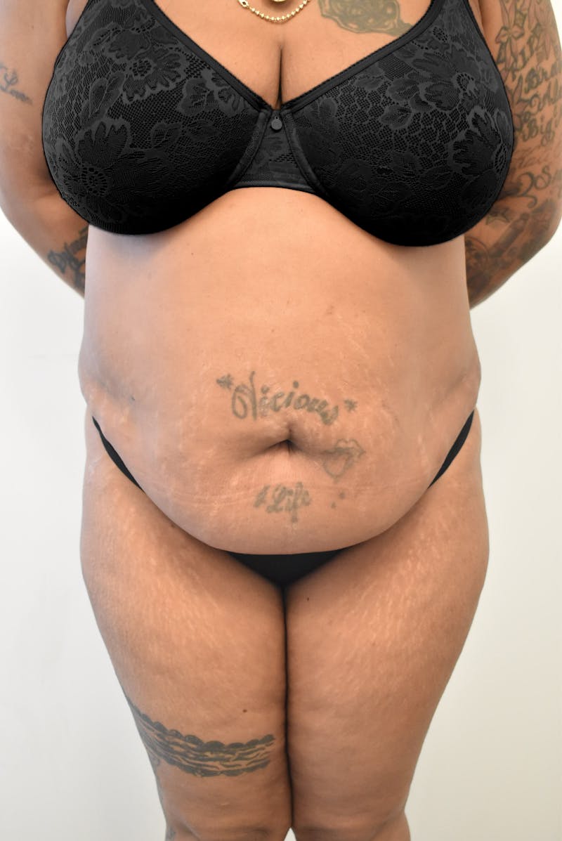 Liposuction Before & After Gallery - Patient 547386 - Image 1