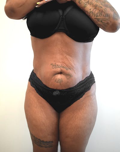 Liposuction Before & After Gallery - Patient 547386 - Image 2