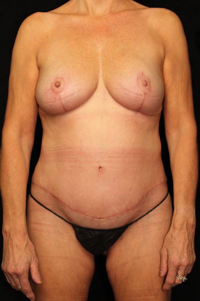 Mommy Makeover Before & After Gallery - Patient 335362 - Image 2